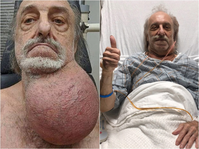 新泽西州一名老翁，成功割除颈部如足球般那么大的肿瘤。网上图片