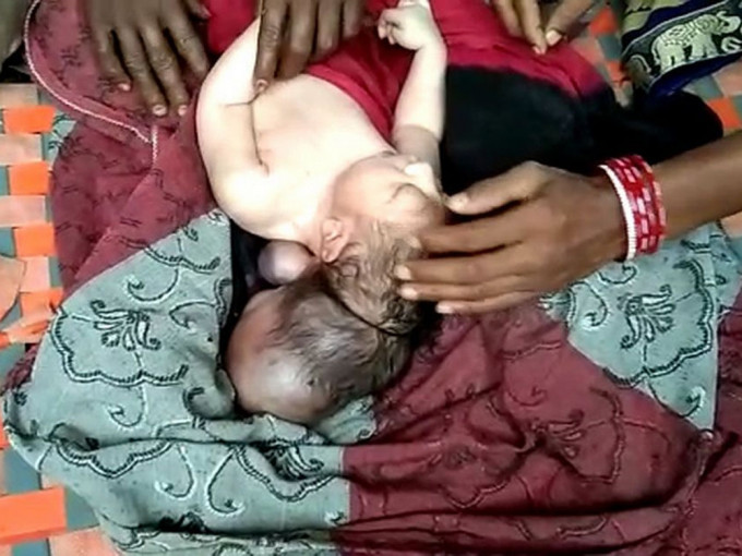 印度妇诞3头女婴。网图