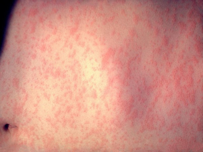 澳门男子感染麻疹。网上图片