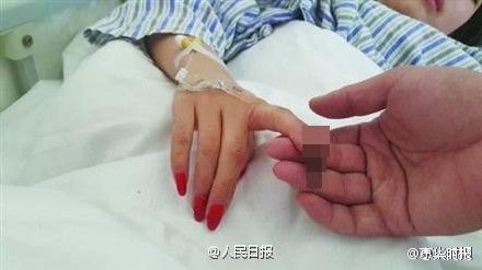 少女两根手指被监生扯断。网图