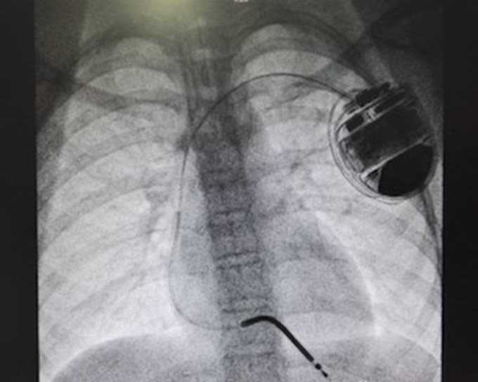 小敏上月底接受植入ICD（埋藏式心臟復律除顫器）手術。網圖
