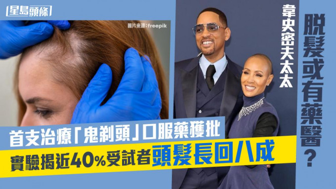 據統計，全美目前每年有逾30萬人受斑禿困擾，其中荷里活男星韋史密夫（Will Smith）太太Jada Pinkett Smith亦是患者之一。