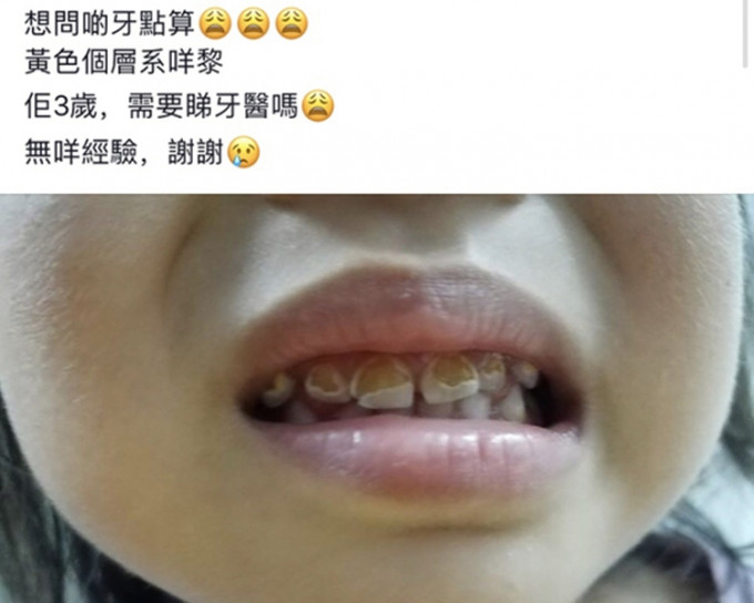 女童上排牙堆着一层厚厚的黄色。facebook