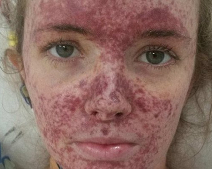女子脸上长满红疹。网图