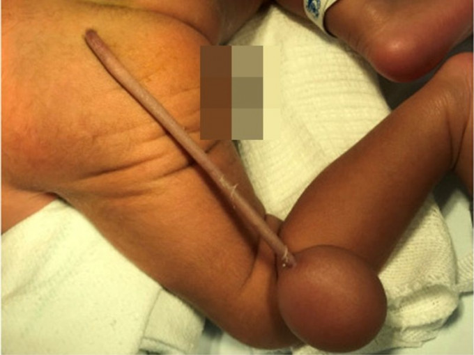 男婴尾部生出一条12公分的尾巴连肉球。图：Journal of Pediatric Surgery Case Reports