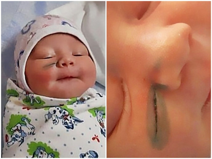 俄羅斯一名新手媽媽剖腹生產後，發現女兒的臉上有一道長約3厘米的傷口。網圖