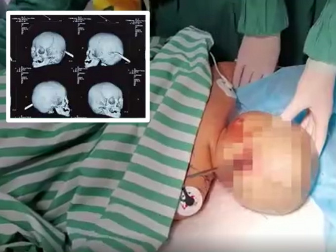 男嬰頭部被一把15厘米修腳刀直插。 影片截圖
