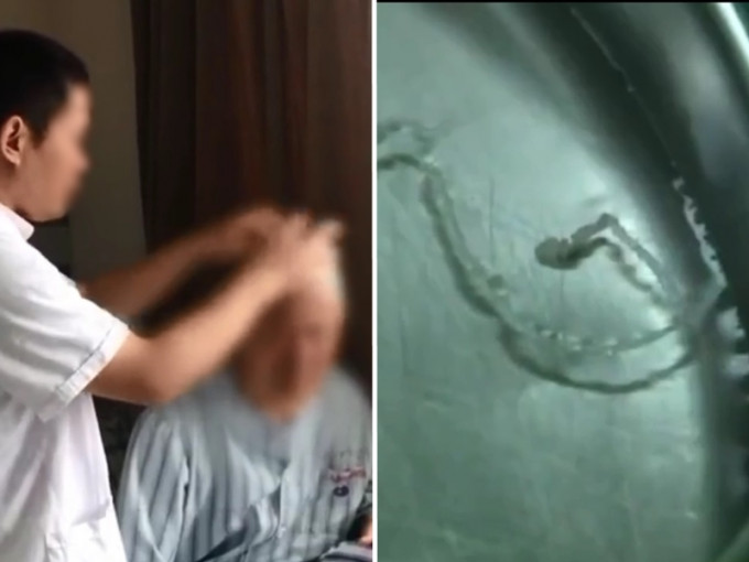 医生指男子是遭到裂头蚴寄生虫感染，透过手术将他头颅内的10厘米活虫取出。 影片截图