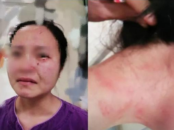 一名外籍新冠肺炎确诊患者在广州市第八人民医院不配合治疗、殴打并咬伤一名女护士。(网图)