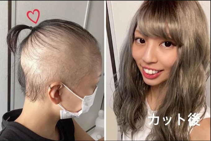 日本女子接種莫德納一個月後變禿頭。網上圖片
