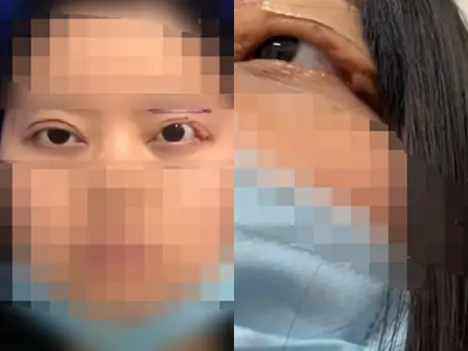 内地一名女子割双眼皮2个月后整块眼皮掉落，致6年无法闭眼。网图