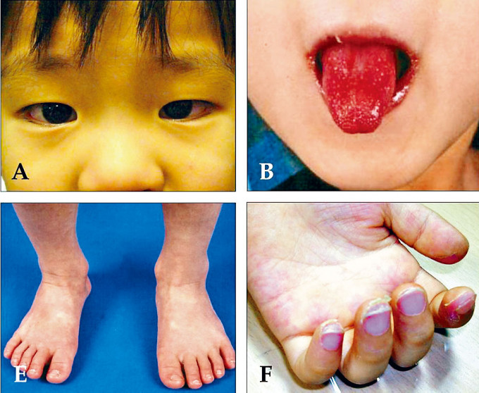 川崎症症狀包括結膜充血、舌頭表面呈草莓狀、腳背紅腫、手指脫皮等。
