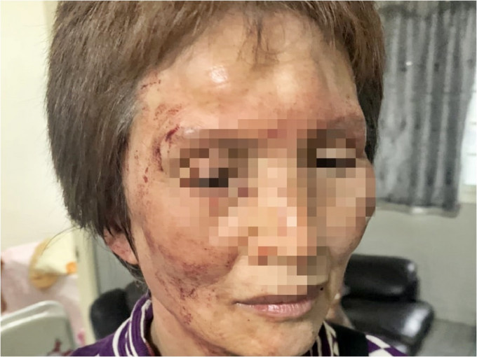 台湾一名老妇遭女租客打伤，需要缝针处理。FB「我是新庄人」图片