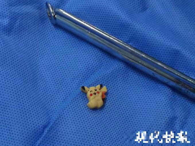 經手術後，醫生從女童的食道內發現一個「比卡超」玩具。網圖