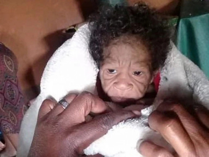 女婴患罕病，出生时满脸皱纹。网图