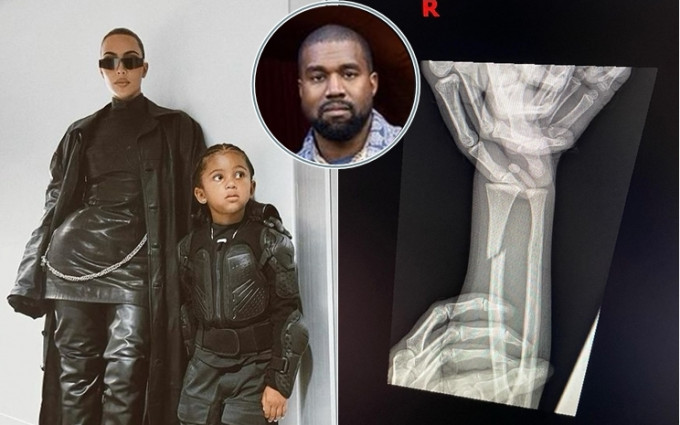 Kanye与Kim的5岁囝囝手臂受伤。