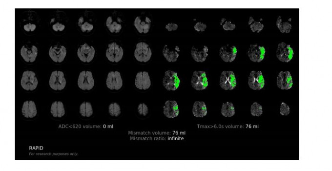 图为人工智能系统的脑部图像分析，绿色为低灌注的脑组织范围（可拯救组织）。绿色范围越大，术后改善病情的机会越大。养和图片