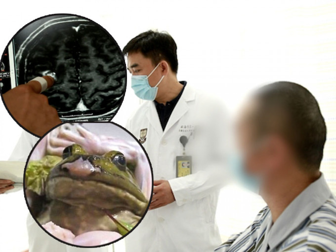 上海男欲治病輕信偏方生吃青蛙，致寄生蟲入腦。
