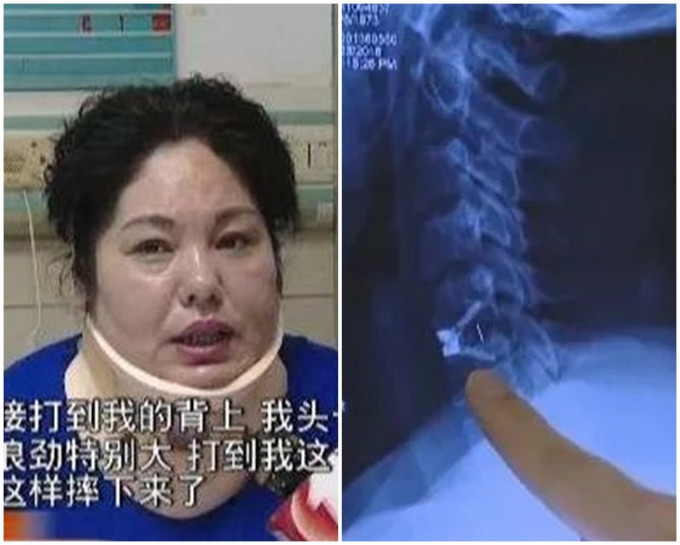 张女受到外力严重撞击，造成椎间盘突出。网图