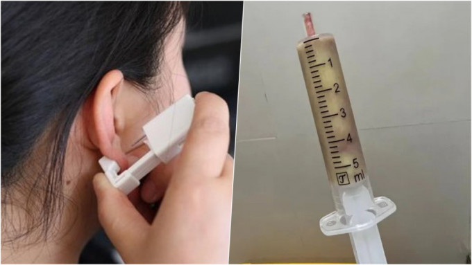  杭州女子买打耳洞神器DIY，结果耳肿如香蕉，抽出一支针筒的脓。 网图