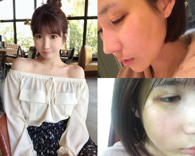 许凯前网红女友大金曾公开面部受伤照片。（网图）