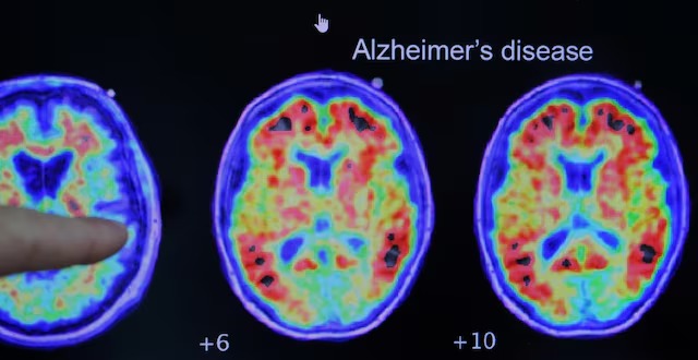 阿茲海默症是最常見的腦退化症類型。路透社