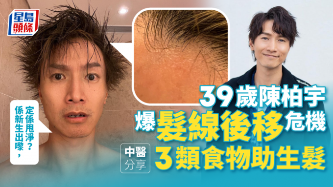 陳柏宇（Jason）近日爆髮線後移危機，中醫師分享生髮貼士對抗中年危機。