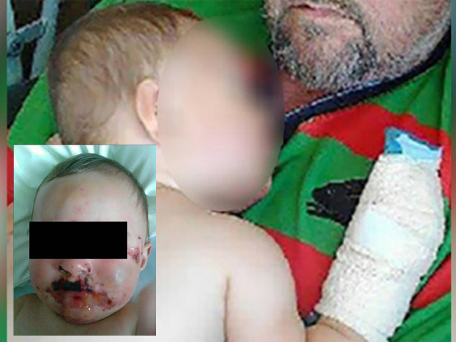 仅9个月大的婴儿被父亲打到重伤，脸部和头部伤痕累累。 网图