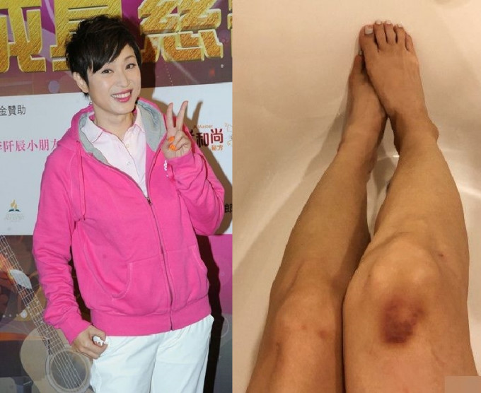 陳法蓉晒傷腳，網民都戥她痛。陳法蓉微博圖片