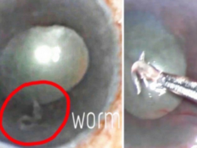 婦人眼內有一條長約1厘米又名眼絲蟲的羅阿羅阿絲蟲（Loa loa）（紅圈）。 網圖
