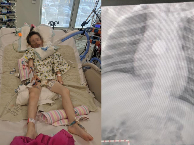 5歲女童暴瘦，多次就醫無果，拍X光片發現原來鈕扣電池惹禍。(網圖)