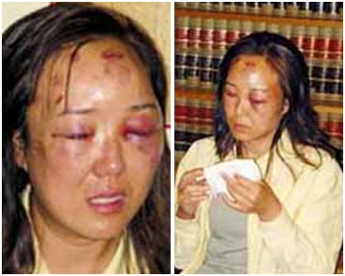 趙燕被打至臉部腫脹，雙眼和前額都受了傷，相片激起大陸震怒。