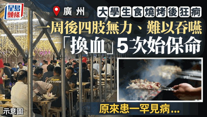 广州有大学生因BBQ疑进食不洁食物，致患罕见免疫系统病，要「换血」5次才保命。