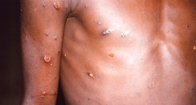 感染猴痘的患者会出现皮疹，形成水泡并结痂。（美联社）