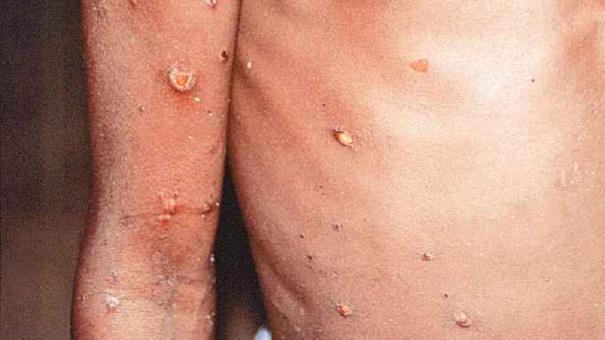 本港发现首宗猴痘输入个案，政府启动猴痘准备及应变计划下戒备级别。 资料图片
