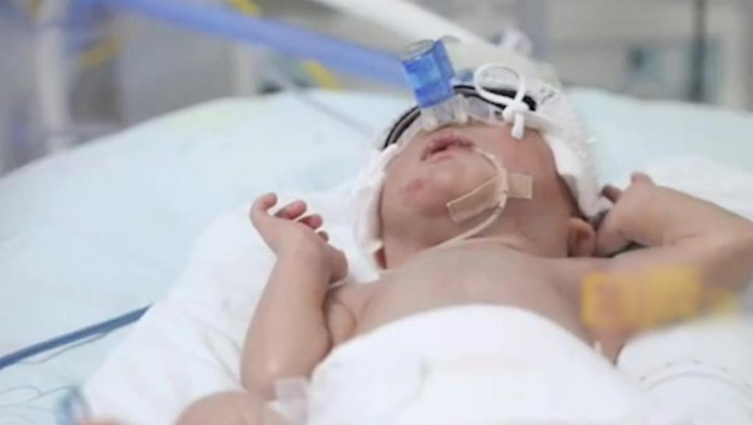 早產的男嬰目前在新生兒科接受治療。互聯網圖片