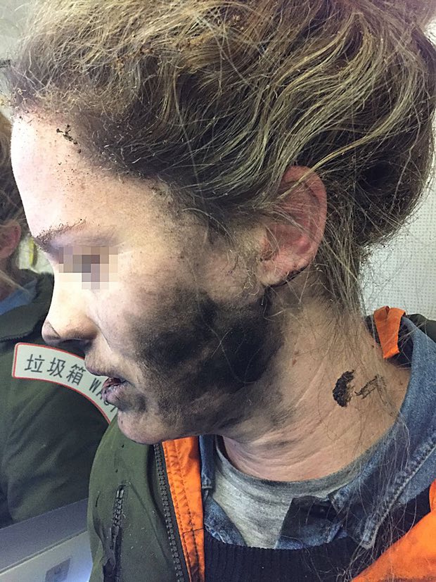女乘客的一邊臉被燻黑。