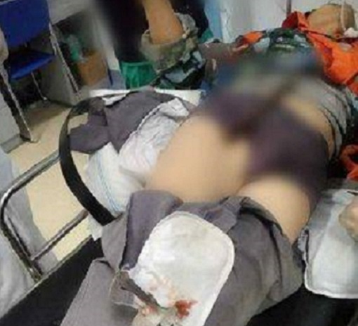 45歲的陳某不小心從工地高處跌落，右大腿被鋼筋刺穿。 網上圖片