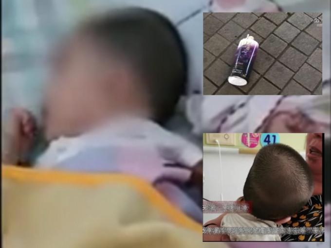 6個月大女嬰遭樓上洗頭水砸中，頭骨骨折未脫離危險期。影片截圖