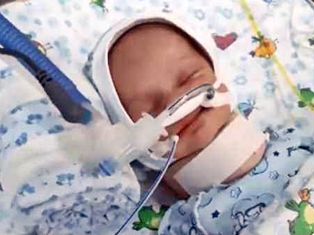 俄羅斯一名男嬰出生時因「真空吸引」而造成頭骨骨折，6周後離世。網圖