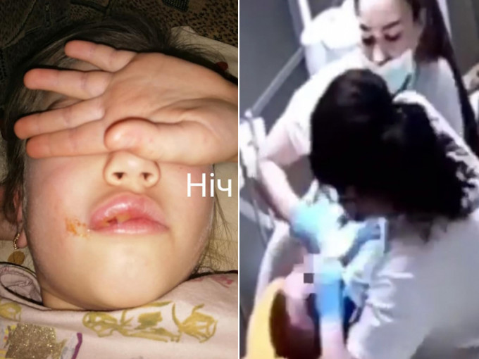 烏克蘭6歲女童睇牙醫後嘴巴異常腫脹，揭醫護曾虐待多名兒童。（網圖）