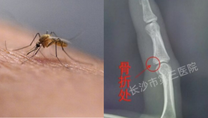 35岁湖南女拍蚊致手指骨折，右图为就医拍下的X光片。