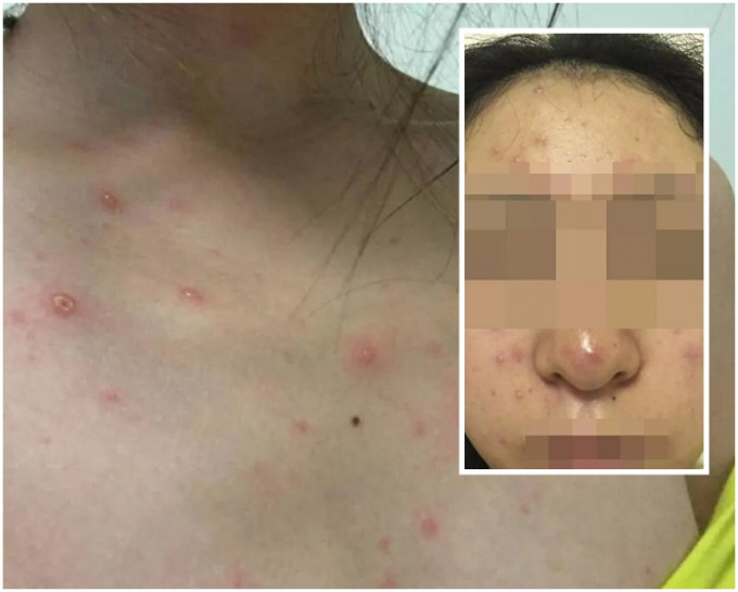 她指现时全身都有疹，包括「嘴里、头皮、脸上、耳朵」都有红疹。