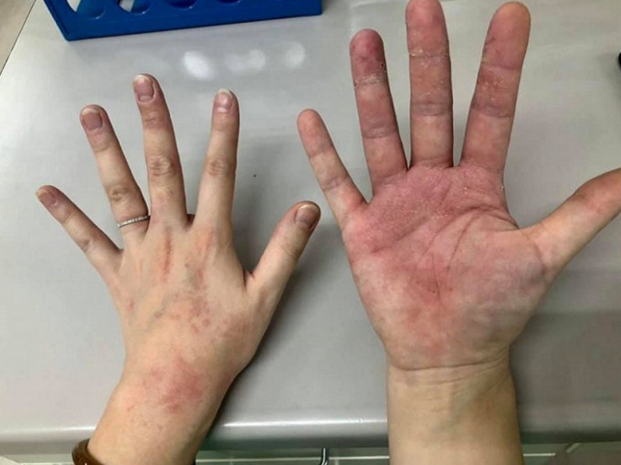 前線抗疫醫護人員雙手長時間戴手套脫皮起紅疹。
