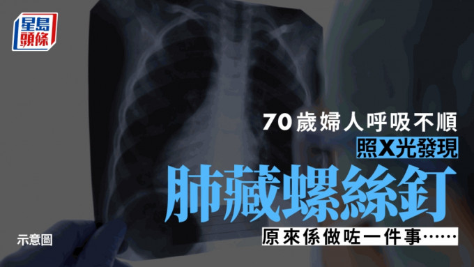 70岁女子呼吸不顺 检查惊见螺丝卡肺。（星岛制图）