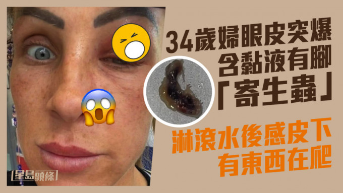 34歲婦眼皮突爆含黏液有腳寄生蟲 淋滾水後感皮下有東西在爬行