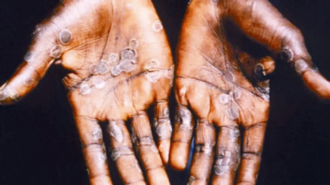 猴痘患者會出現皮疹症狀。