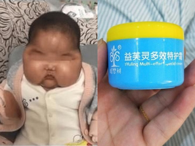 5个月大的婴儿使用面霜后变大头娃娃，检测发现面霜含糖皮质激素。