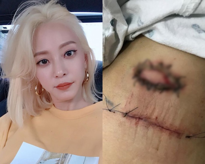 韓藝瑟入院切除脂肪瘤兩個星期後，傷疤仍未愈合令她非常傷心。