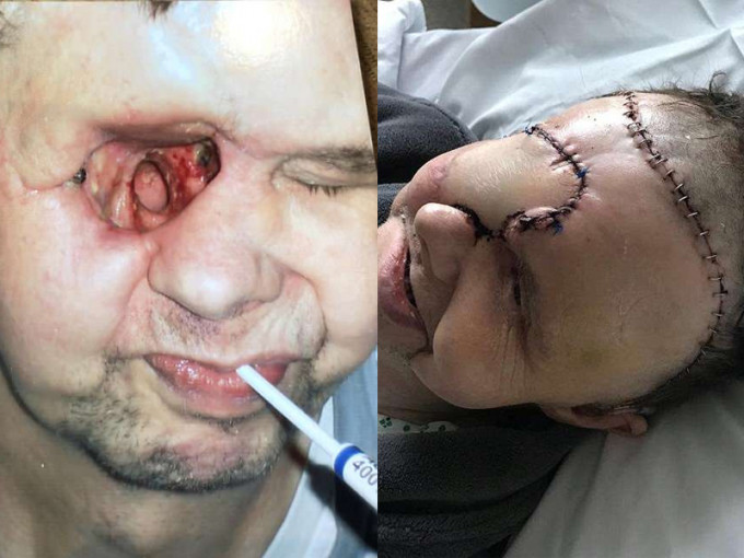 因延誤治療，亨特需要切除右眼球和部份面骨，手術後右眼位置留下一個大洞，嚴重影響生活。（網圖）